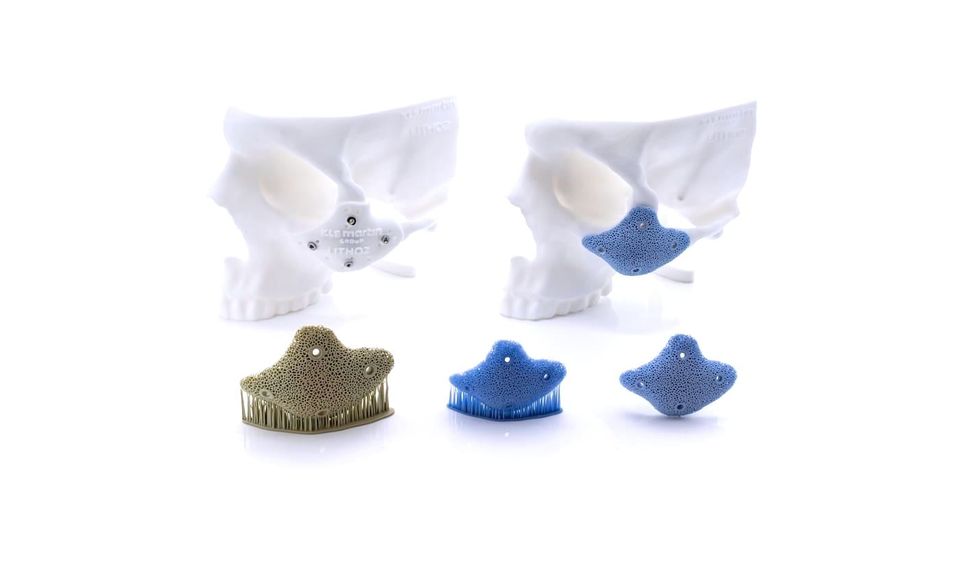 KLS Martin Nears 500th 3D Printed Ceramic Implant
