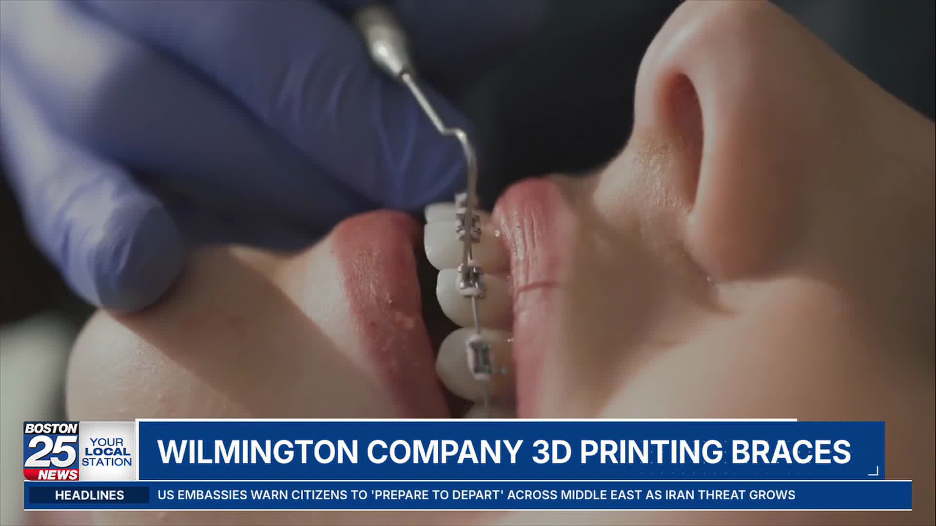 LightForce 3D Prints Custom Metal Braces Near Boston