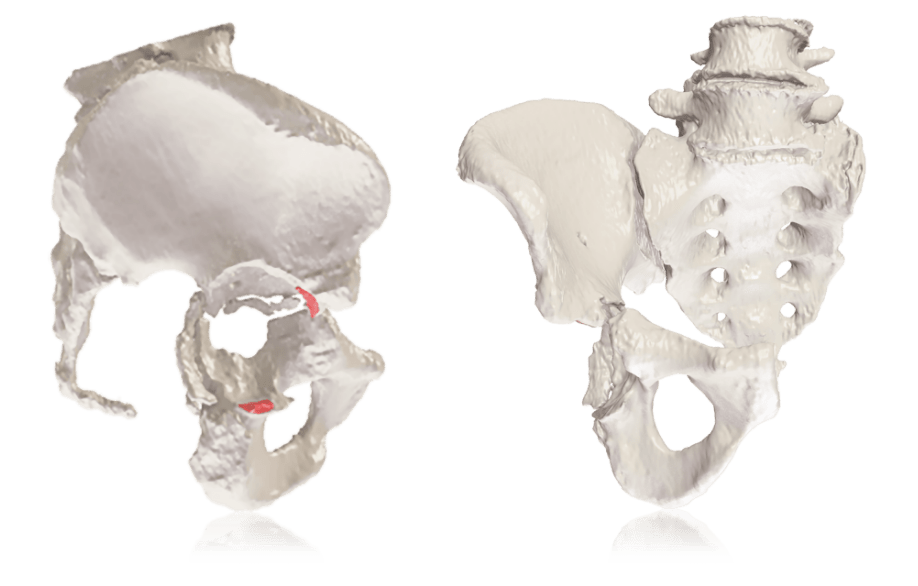 Onkos Surgical Reaches 1,000 Cases With 3D-Printed Pelvic Implants