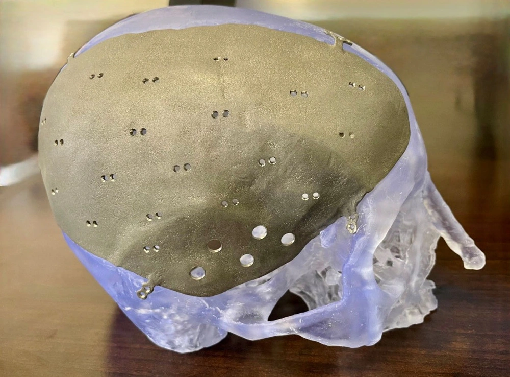 Walter Reed Wins FDA Clearance for 3D-Printed Titanium Cranial Implants
